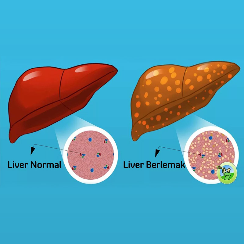 Hydrogen recommendations for fatty liver.