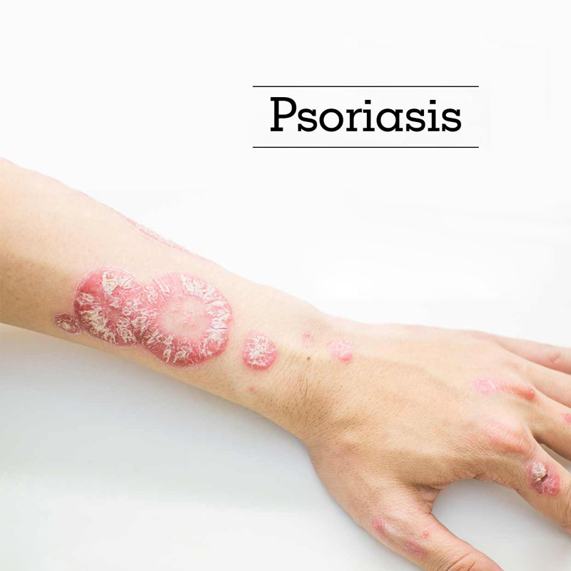 The positive effect of hydrogen bath on psoriasis and plaque parapsoriasis